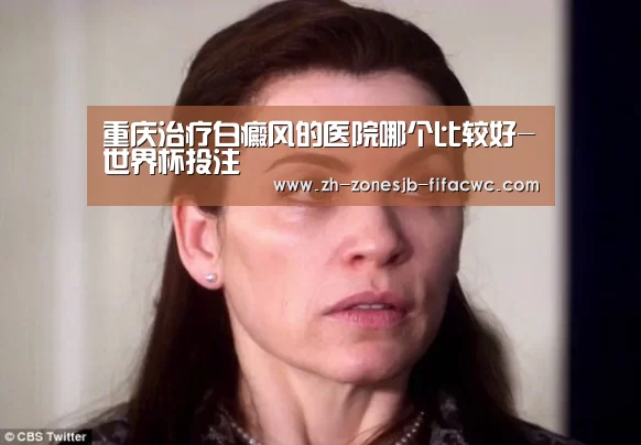 重庆治疗白癜风的医院哪个比较好-世界杯投注(图3) 世界杯外围买球官网